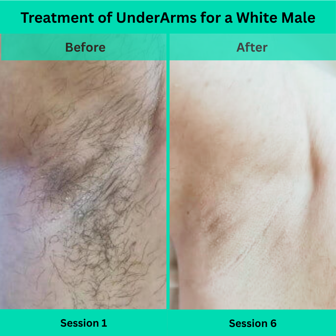 Before and After picture of Laser Hair Removal Treatment of UnderArms for a White Male